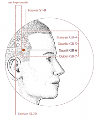 In the temporal region, within the hairline, three quarters of the distance between St-8 and GB-7.