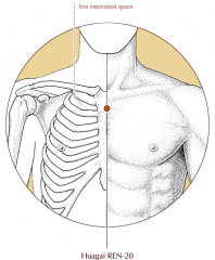 On the midline of the sternum, level with the junction of the first intercostal space and the sternum.