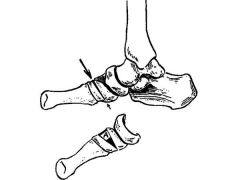 posterior tibial tendon insufficiency =stage3
physical exam findings stage III
forefoot abduction = "too many toes"
Pes planus= x-ray subtalar arthritis and arch collapse
Hindfoot valgus = rigid, cannot do single leg heel raise
Equinus contracture...