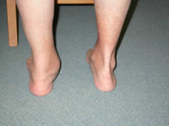 A 53-year-old female has a 20 month history of left hindfoot pain that has failed to respond to AFO bracing and physical therapy. She has a unilateral planovalgus deformity, shown in Figure A, which is flexible. She is unable to do a single leg-he...