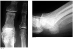 patient complains of shoe irritation of the 1st MTP joint physical exam positive with grinding test


what the diagnosis
What the treatmentin a runner
What kind of orthotic
Was a treatment elderly low demand patient with significant degenerative...