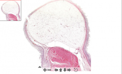 - Huge nodule(s) of adipose tissue in submucosa

ETIOLOGY