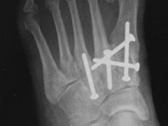 The history, clinical images, and radiographs are consistent with a Lisfranc injury. Instability of the Lisfranc joint is the result of injury to both the interosseous first cuneiform-second metatarsal ligament (Lisfranc's ligament) and the planta...
