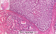 - Normal colon partly
- Very irregular glandular cells and tubules other places
- Mitotic activity and invade smooth muscle layers

ETIOLOGY
