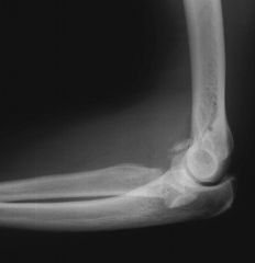 what is the diagnosis
was the most common complication with posterior lateral approach to the radial head
most common prevention step taken during surgery