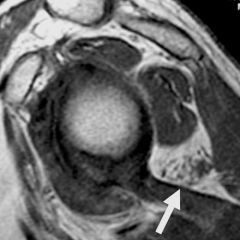 Patient presents with pain and paresthesias with overhead activities no history of trauma other than being a baseball pitcher


With the diagnosis
with the next best diagnostic study to confirm the diagnosis
With the next most appropriate step i...