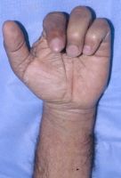 patient presents with weak grip with the diagnosis
What the cause
 
With the treatment