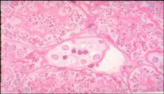 What pathology is demonstrated here?
 
What syndrome is it associated with?