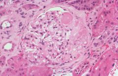 Bubbly appearing lipids & pink hyaline on left, area of collapse of the basement membrane
 
NephrOtic Syndrome - 
Focual Segmental Glomerulosclerosis