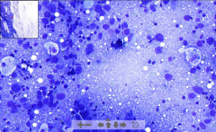 - FNAC (fine needle aspiration cytology) of a cancerous lesion
Blue dots:
- Pleomorphic cells
- High nuclear/cytoplasmic ratio
- Hyperchromatic nuclei