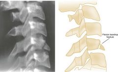 Flexionteardrop

Anteriordisplacement of teardrop-shaped fragment from anteroinferior vertebrae