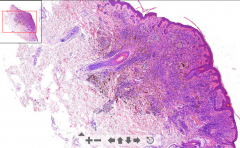 - Dermal nevus (føflekk)
- Melanin seen above nevus
- Melanocytes in deeper layers produce melanin
- Cluster of melanocytes = brownish

ETIOLOGY