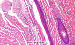 - Cystic cavity lined by stratified squamous epithelium
- Keratin in lamellar arrangement

ETIOLOGY