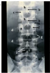 label- where would you put the needle in an LP?

What do the vertebrate on an AP Xray look like?