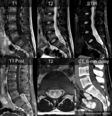 a.Isointense with spinal cord on T1-weighted images and hyperintense on T2-weighted images; enhancement is heterogeneous and intense.
b.Commonly a rim of hypointense signal surrounding the intramedullary tumor on T2-weighted images.