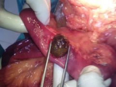 Gallstone ileus
- gallstone entering the intestine through a fistula (cholecystoenteric fistula) and getting lodged in the intestine creating an obstruction at the ileocecal valve
