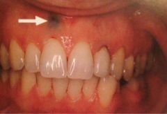 Inadvertent tattoo of gingiva from dental amalgam introduced through a mucosal laceration