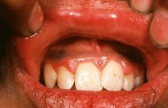 What did this patient ingest?