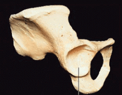 The depression on the lateral pelvis where its three component bones join in, in which the femoral head fits snuggly.