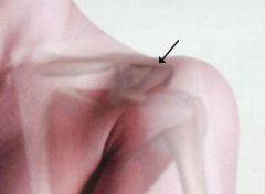A simple joint where the bony projections of the scapula and the clavicle meet at the top of the shoulder.