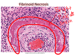 Fibrinoid necrosis