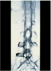the venous pleuxus draining the spinal cord. it has no valves so things spread easily through them