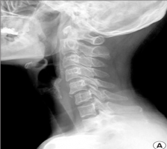 Identify?
Which vertebra is #?
What are you going to see on  AP x ray?
What do you call this finding on Lateral x ray?