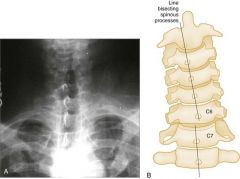 Unilateral
facet dislocation.
Ant
displacement < 50% of vertebral body on lateral XR (the # is in the one above)AP
Xray shows SP off midline,
Lateral Xray “Bowtie”