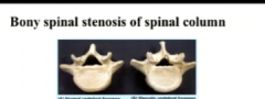spinal stenosis from osteophytes