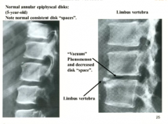 What can look like a limbus vertebra? (dis herniation)