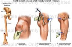 Which of the following factors is most associated w/ malrotation during antegrade or retrograde femoral nailing? 1-Surgeon experience; 2-Level of primary fx line; 3-Use of a piriformis starting portal 
4-Fx comminution; 5-CR technique