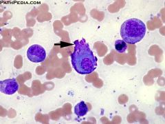 Antibody plasma cell w/ intense eosinophilic
cytoplasm; may be seen in IgA myelomas