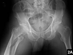 P/o varus alignment of an unstable subtroch fem fx Tx w/ an IM nail has been shown to be related to which of the f/u factors? 1-Use of a piriformis entry nail through a greater troch entry portal; 2-Use of a greater troch entry nail through a piri...