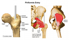 entry portal 3-Use of a lat entry nail through a piriformis entry portal; 4-Use of a fem distractor device to obtain redtn; 5-Use of a fx table to obtain redtn:::advancement of the nail causes the two axes to become colinear, leading to varus,:::Ans1