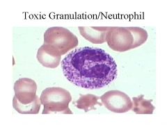 altered primary
granules w/c contain myeloperoxidase; seen in chemical poisoning