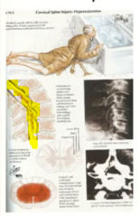short- can fall and poke bones into spinal cord
long- constantly compressed nerves will degenerate