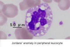 Granulocytes and monocytes w/fat
 containing vacuoles; seen in ictosis &
muscle dystrophy
