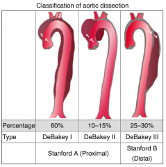 Aortic dissection (Type A) causing aortic regurgitation