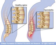 AS is a form of spondyloarthritis, a chronic, inflammatory arthritis where immune mechanisms are thought to have a key role. It mainly affects joints in the spine and the sacroiliac joint in the pelvis, and can cause eventual fusion of the spine.
...