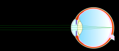 If an individualwants to look at an object close to them the light rays will be diverging morethus more refractive power is needed to bring the rays together. The lens willbe made fatter and this will refract the light nicely onto the retina and i...