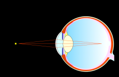 The individualwith a myopic eye will look at something close and lens will bulge as lightrays are more divergent.
However, the power of the optics is too strong andthus the light rays and image will be refracted so strongly it will focus infront o...