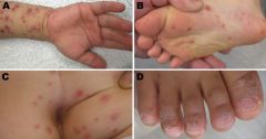  
common acute disease of young children during the spring and summer caused by Coxsakie A viruses
there is usually a prodrome of fever, anorexia, and oral pain followed by crops of ulcers on the tongue and oral mucosa, as well as a vesicular ras...