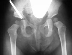 name this osteotomy can be used to younger patient with open triradiate cartilage
what is the technique  to perform