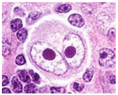 Hodgkin's Reed Sternberg Cell characterized by large size, bilobed nucleus, and nucleolar inclusion bodies "owl's eyes"