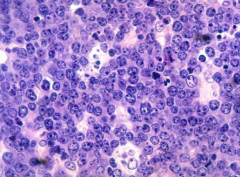 Highly aggressive B cell non-Hodgkin lymhoma
- Sheets of lymphocytes with interspersed macrophages