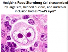 Reed-Sternberg Cells looks like Owl's eyes
- Sign of Hodgkin's Lymphoma