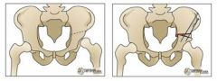 salter
Single cut above the acetabulum through the tissue him into the sciatic notch
the acetabulum changes through the pubic symphysis and is every directional osteotomy to provide additional lateral anterior coverage main lengthening leg up to 1 cm