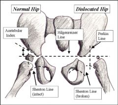 perpendicular line to Hilgenreiner's line through a point at the lateral margin of the acetabulum
femoral head should be medial to this linehat is Shenton's line