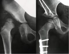 name this osteotomy used for moderate to severe DDH and the triradiate cartilage is open
what is the technique to perform
what is the affect acetabular and why don't you need fixation with