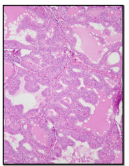 Autoimmune
- diffuse involvement
- microscopic appearance
-- irregular follicles
-- scalloped colloid